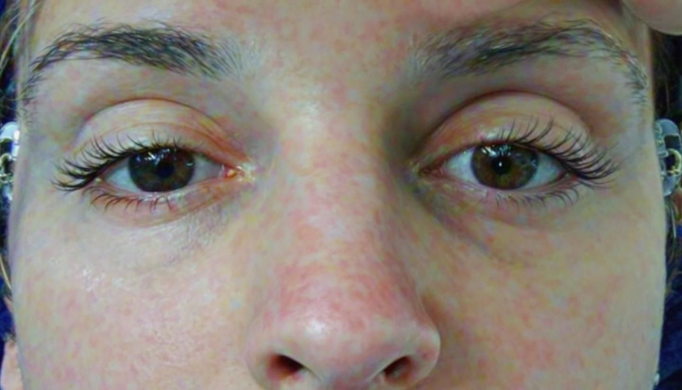 Exploration des avantages de la rhinoplastie ultrasonique pour une esthétique améliorée